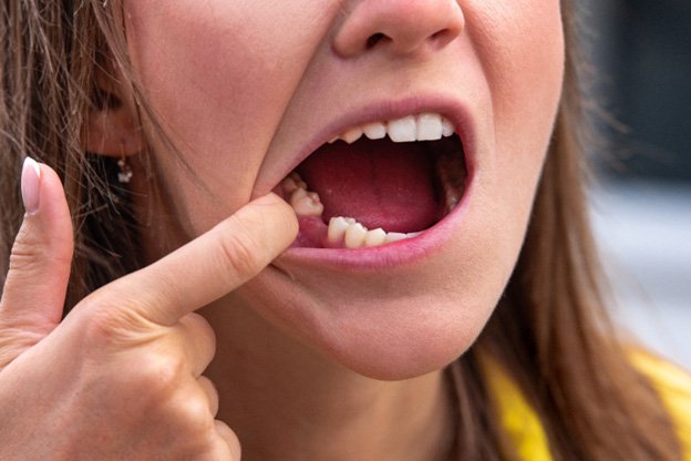 Woman pulling cheek back showing missing tooth
