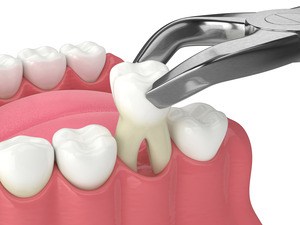 Illustration of tooth being extracted by forceps