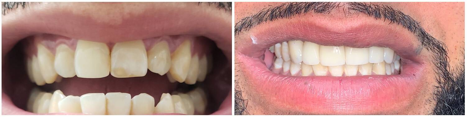 Smiles of Memorial - Before and After Image - Dentist Houston