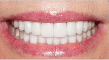 Smile Gallery - After Image- Dentist in Houston TX