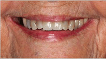 Smiles of Memorial - After Image - Houston Dentist