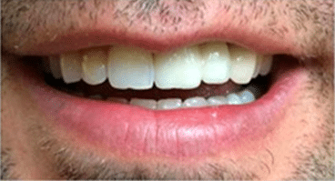 Smiles of Memorial - After Image - Houston Dentist Near Me