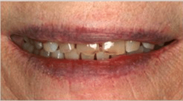 Smile Gallery - Before Image- Dentist Houston