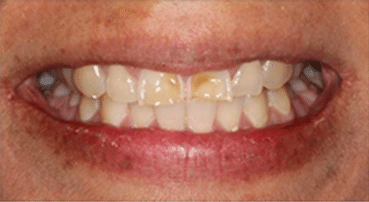 Smile Gallery - Before Image- Houston Dentist