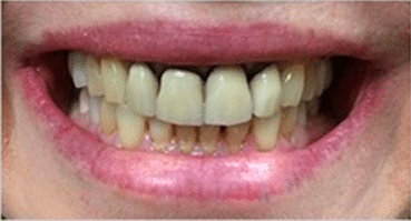 Smile Gallery - Before Image- Dentist in Houston TX