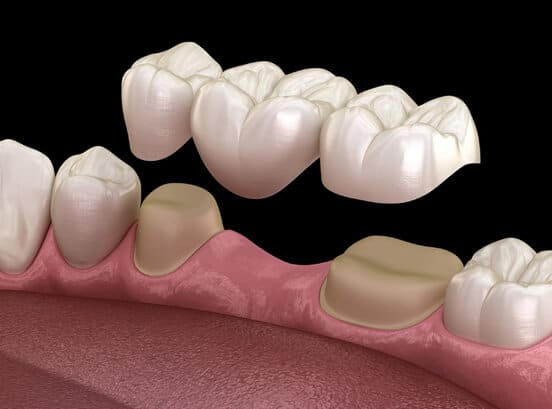 dental_implant_bridge_dentist_houston