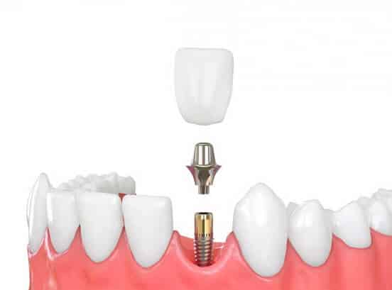 dental_implant_crown_dentist_in_houston