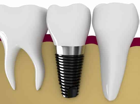 dental_implant_post_houston_tx