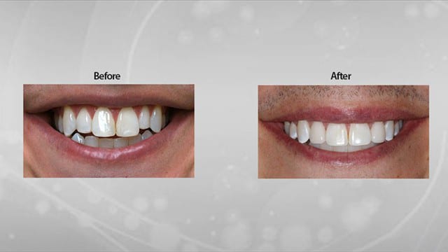 Dental Veneers Houston - Before and After Image
