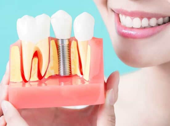 what-is-a-dental-implant-houston dentist