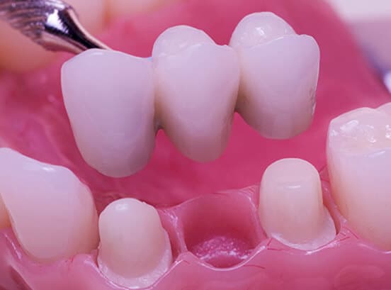 what_is_a_dental_implant_bridge_houston_tx