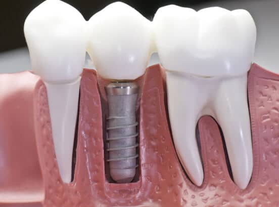 what_is_an_abutment_dentist_houston