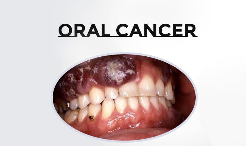 oral cancer