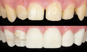 Comparison Between Dental Bonding & Veneers