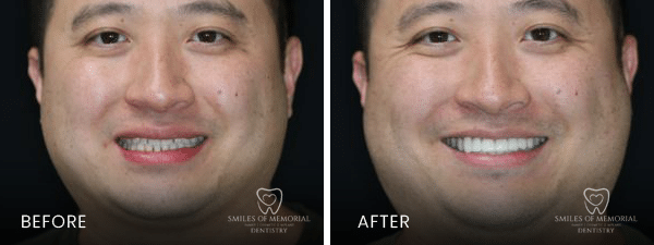 Dental Cleaning Houston - Before and After Image