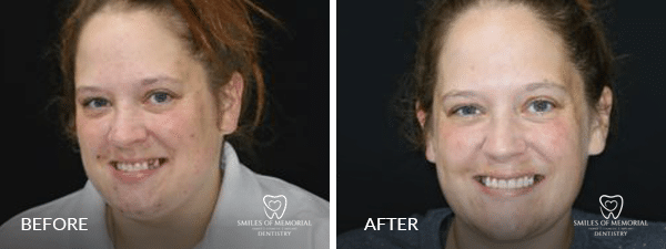 Dental Implants in Houston - Before and After Image