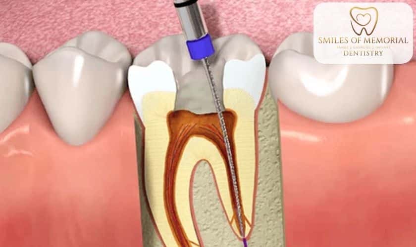 The Potential Dangers Of An Incomplete Root Canal