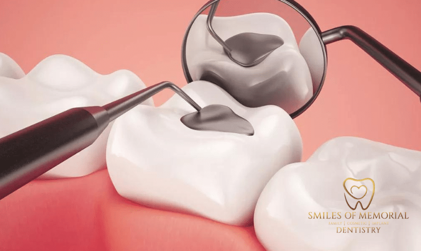 Take Care of Dental Sealants