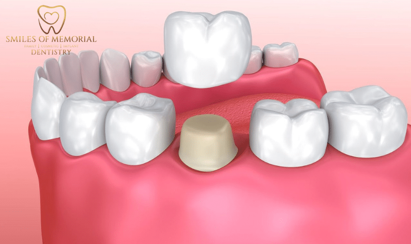 Ideal Candidates for Dental Crowns