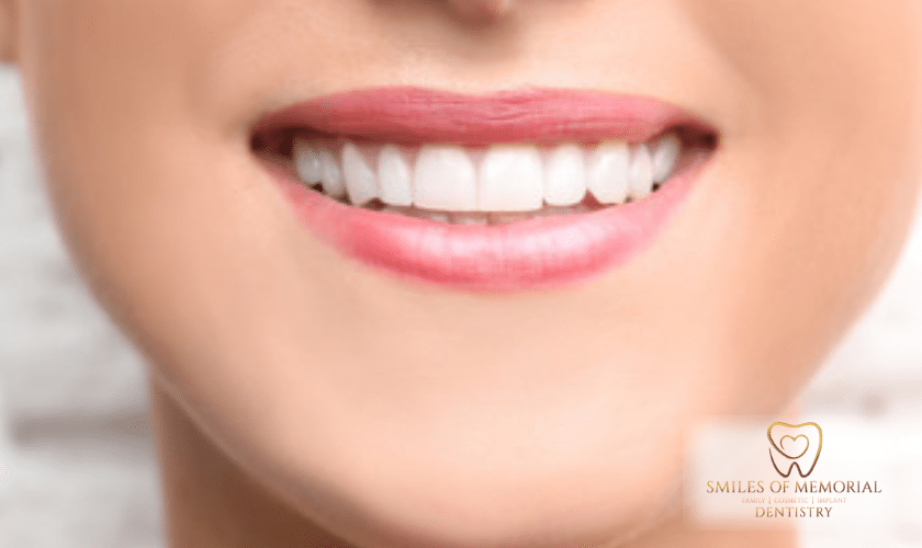 Common Dental Problems Solved by Bonding Procedures