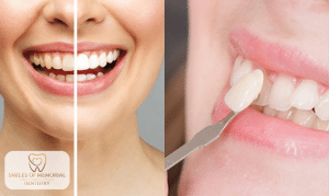 Dental Veneers vs Teeth Whitening