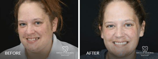 After and Before effect of dental treatment - Dentist in Houston - Smiles of Memorial Of Houston - Viet Tran DMD