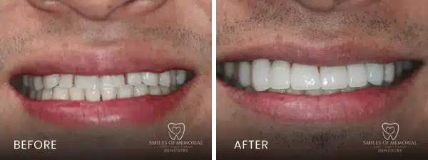 After and Before effect of dental treatment - Dentist Houston - Smiles of Memorial Of Houston - Viet Tran DMD