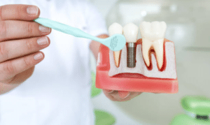 dental implant Houston - are dental implants right for you factors to consider