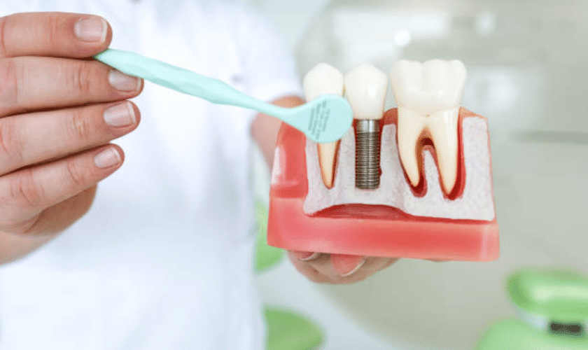 dental implant Houston - are dental implants right for you factors to consider