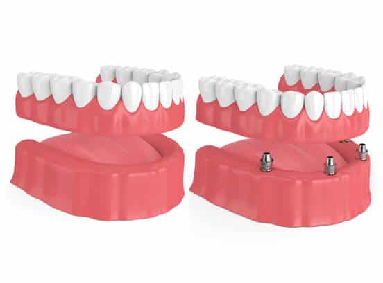 Implants Vs. Dentures - Dental Implant Houston - Smiles Of Memorial Of Houston - Viet Tran Dmd