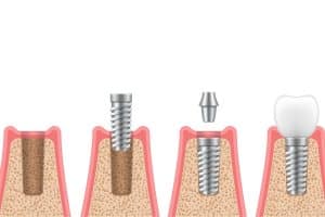 How long do dental implants take